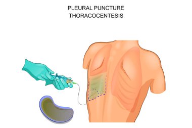 thoracocentesis, plevral ponksiyon