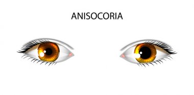 anisocoria. öğrenciler farklı boyutlarda