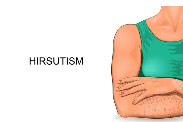 Le corps d'une femme souffrant d'hirsutisme — Image vectorielle