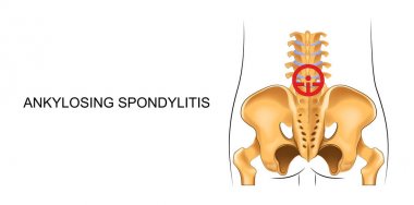 lower back, suffering from ankylosing spondylitis clipart