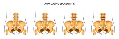 lomber de Ankilozan Spondilit gelişimine