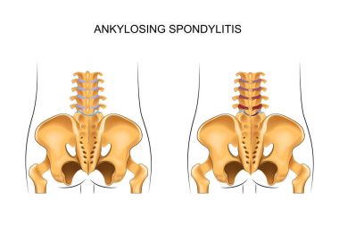 sağlıklı alt sırt ve Ankilozan Spondilit