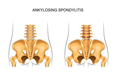 healthy lower back and ankylosing spondylitis clipart