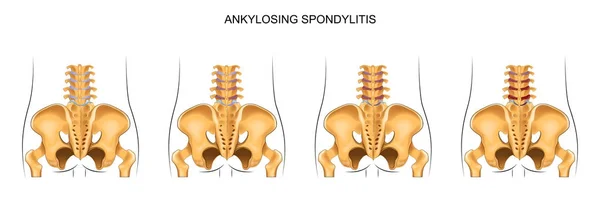 Lo sviluppo di spondilite anchilosante nella colonna vertebrale lombare — Vettoriale Stock