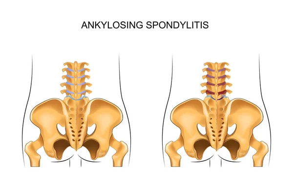 Sağlıklı alt sırt ve Ankilozan Spondilit — Stok Vektör