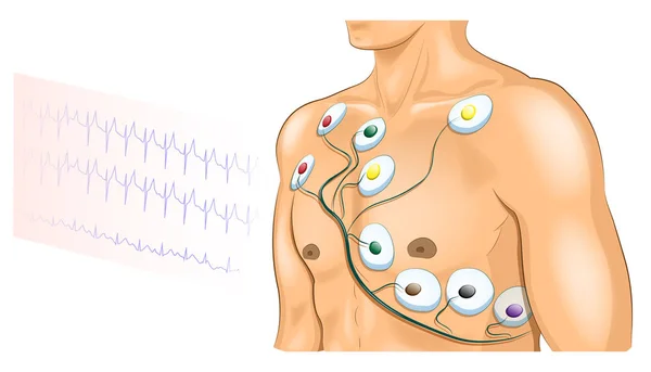 EKG-elektroder på bröstet av idrottaren — Stock vektor