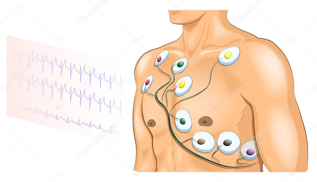 ECG electrodes on the chest of the athlete