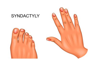 syndactyly. el ve ayak perdeli