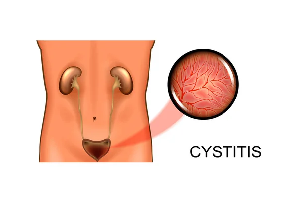Urinvägarna. cystit — Stock vektor