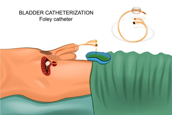 Bladder catheterization with a Foley catheter — Stock Vector