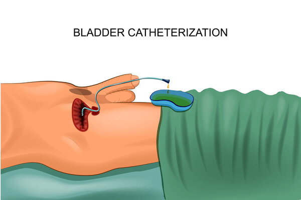 catheterization of the bladder. the catheter