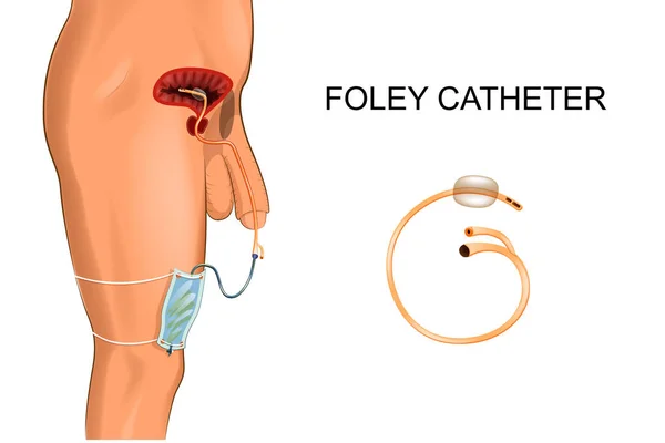 Καθετήρα Foley. μια τσάντα για συλλογή ούρα — Διανυσματικό Αρχείο