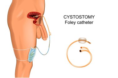 cystostomy. Foley kateter