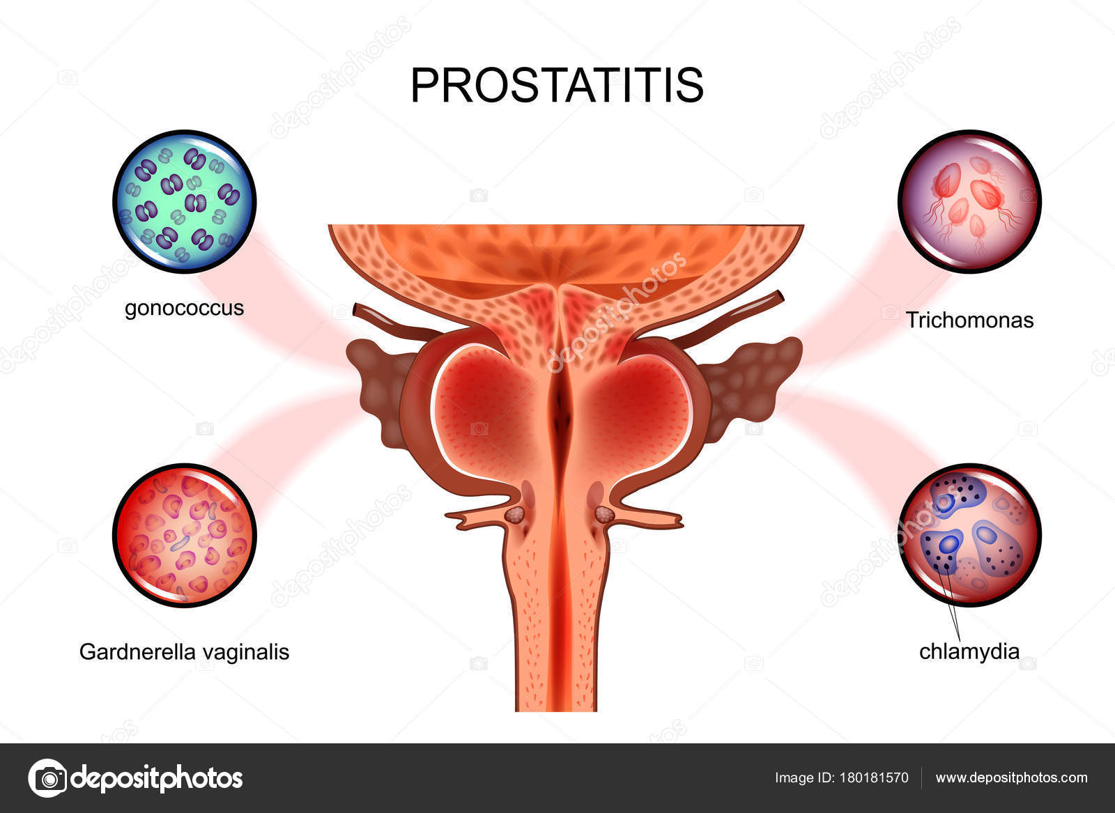 instesztinális fertőzés és prostatitis