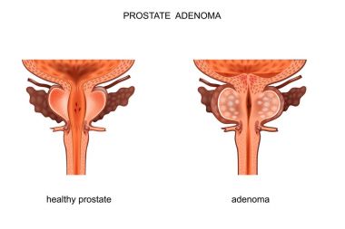 healthy prostate and BPH clipart