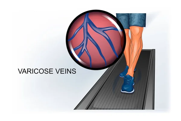 Πόδι του αθλητή, που πάσχουν από τις κιρσώδεις φλέβες — Διανυσματικό Αρχείο