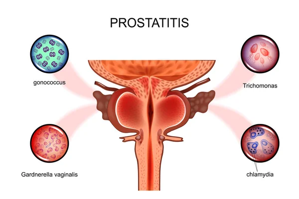 Une prostatite. infections sexuelles — Image vectorielle