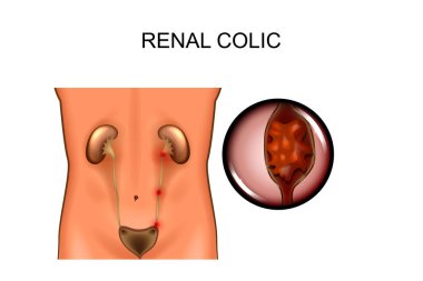 Renal kolik. Mekanlar