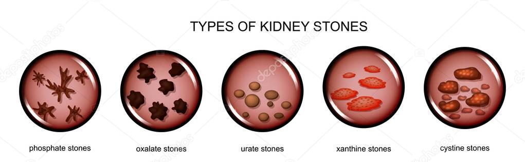 Types of kidney stones — Stock Illustration Types of kidney stones Stock Illustration