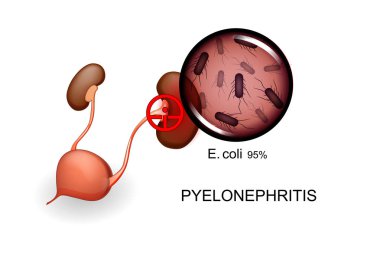 bladder and kidneys. pyelonephritis clipart