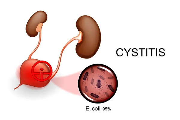 Bexiga e rins. cistite — Vetor de Stock