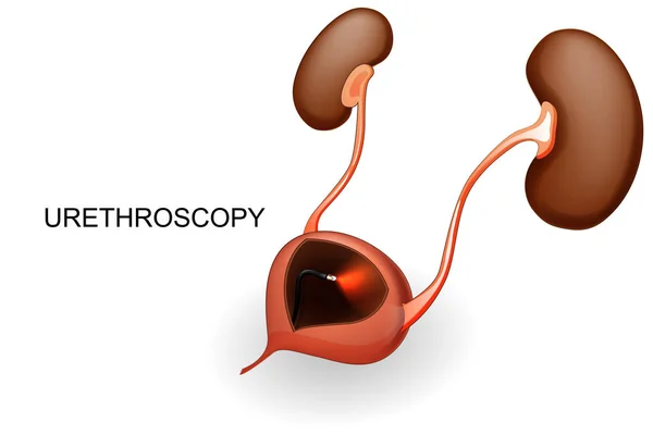Bladder and kidneys. urethroscopy. — Stock Vector