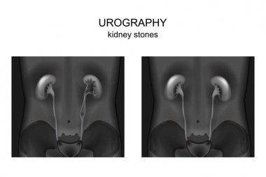 urography. böbrek taşı