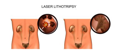 Lazer litotripsi ve böbrekler gelen kum kaldırılması