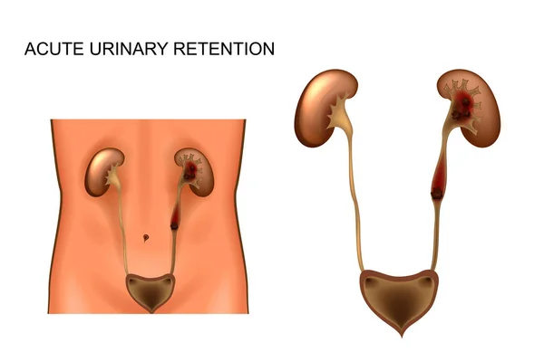 急性尿閉 — ストックベクタ