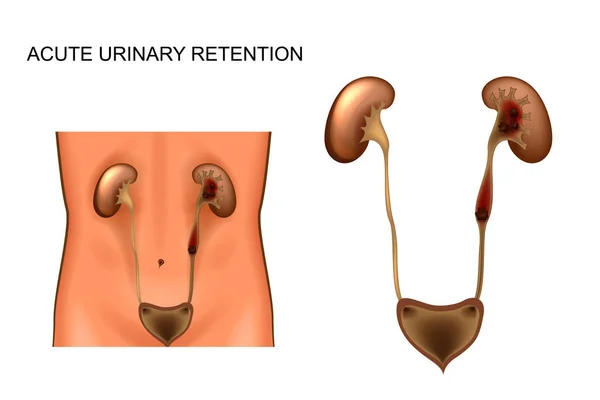 Acute urinary retention — Stock Illustration Acute urinary retention Royalty Free Stock Illustrations