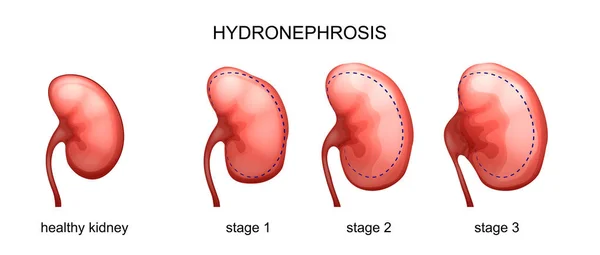 A színpadon a hydronephrosis — Stock Vector