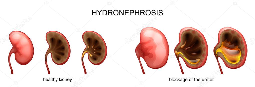 blockage of the ureter . hydronephrosis.