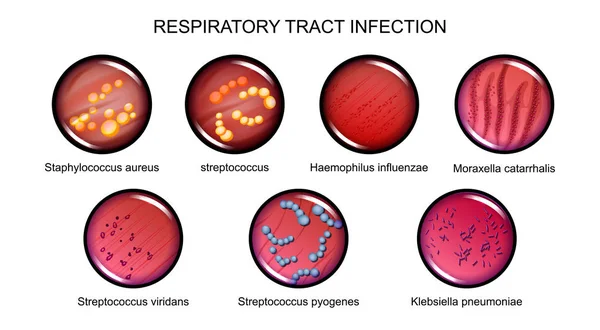 Infección de vías respiratorias — Vector de stock