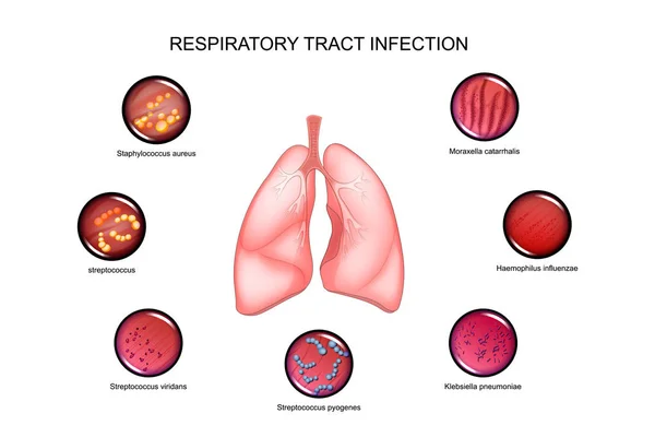 Infecciones pulmonares y respiratorias — Vector de stock