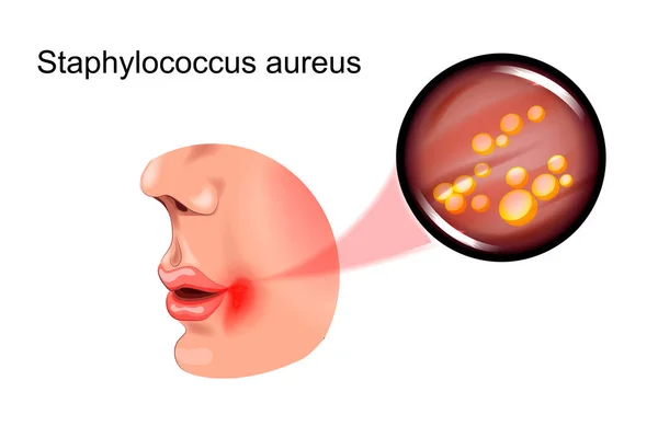 Sore on the face. staphylococcus — Stock Vector