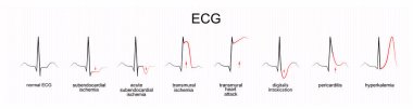 EKG yorumlanması