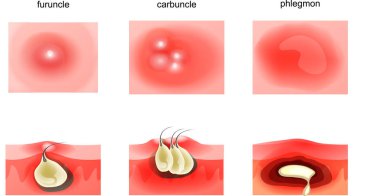 suppurative diseases of the skin clipart