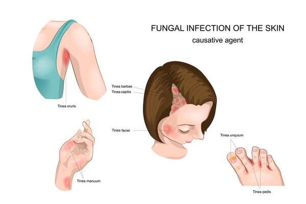 fungal diseases of skin, nails and hair
