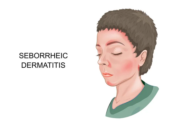 Seborrheic 피부염 — 스톡 벡터