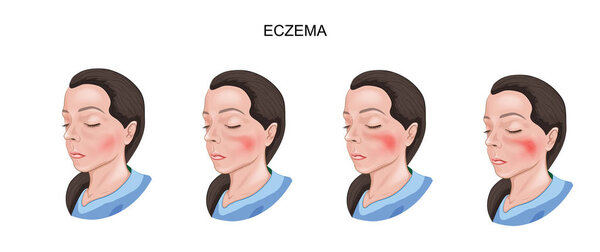 damage eczema of the skin