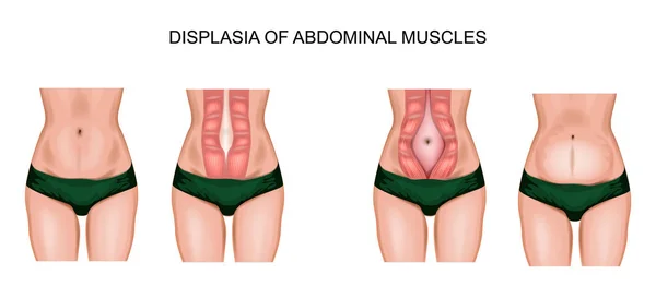 복 부 근육의 diastasis — 스톡 벡터