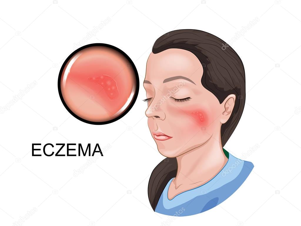 ECZEMA