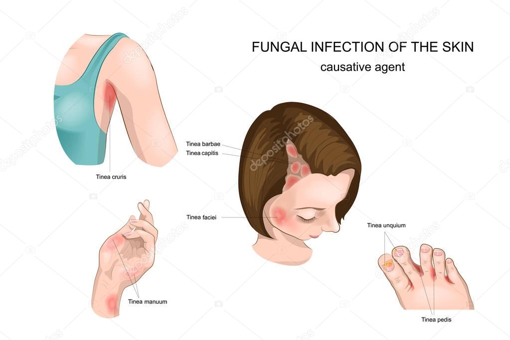 fungal diseases of skin, nails and hair