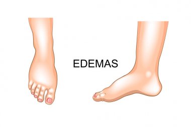 foot swelling. edema clipart