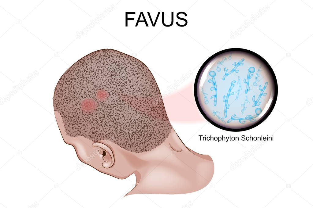 favus. the causative agent of favus