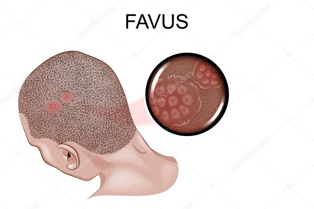 vector illustration of the favus. fungal infection of the skin