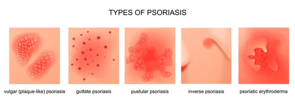 Tipos de psoriasis — Archivo Imágenes Vectoriales