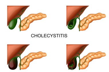 liver, gall bladder and pancreas. cholecystitis clipart