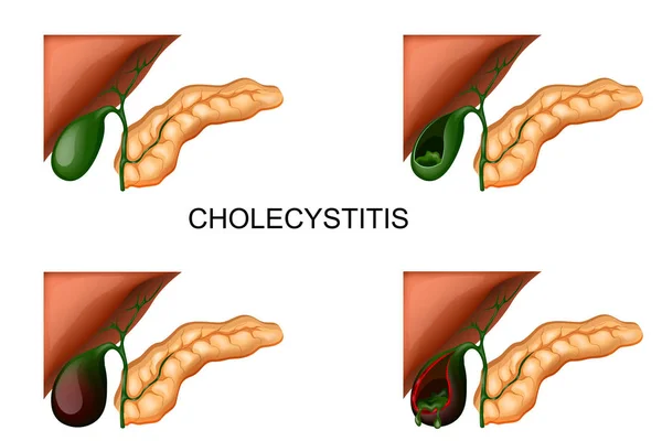 Печінка, жовчний міхур і підшлункова залоза. холецистит — стоковий вектор