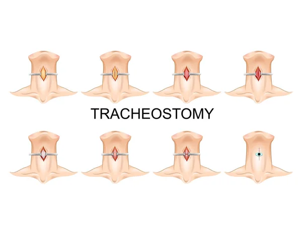 Tubo de traqueostomía. cirugía — Vector de stock